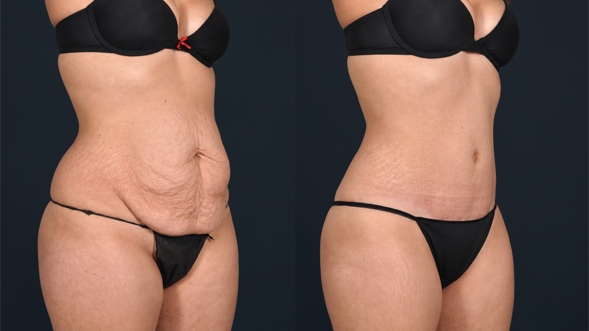 360 Liposuction before treatment